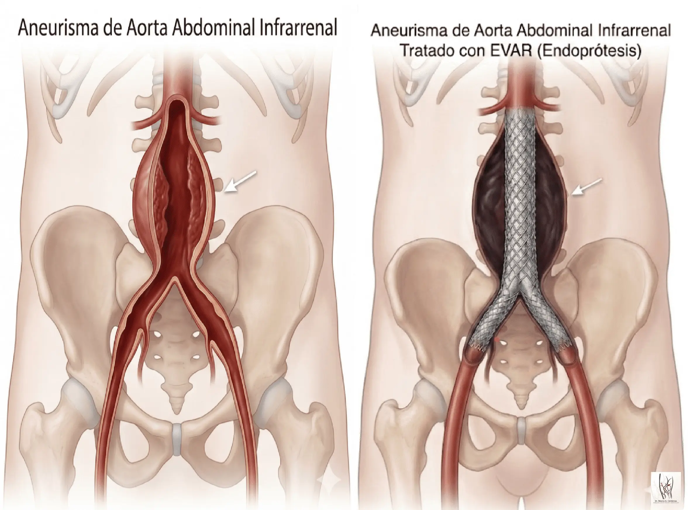 EVAR Aneurisma Abdominal